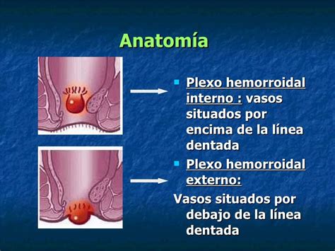 Fotos de hemorroides externas e internas (almorranas)